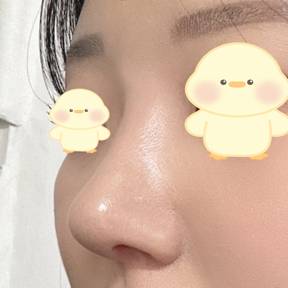 코가 정말 예뻐져서 만족하고 지내고 있습니다 !