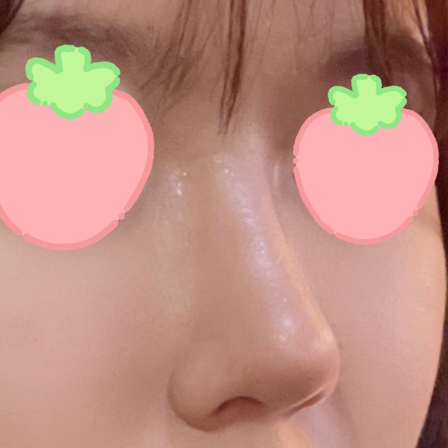 코성형 후 만족스러운 삶 보내고 있어요!