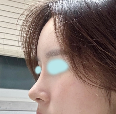 유영문원장님께 코, 지방이식 받았습니다!