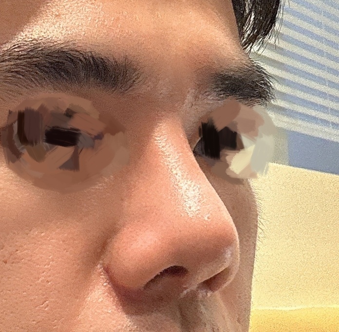 남자코성형 바이브 적극추천 완전 강추입니다!