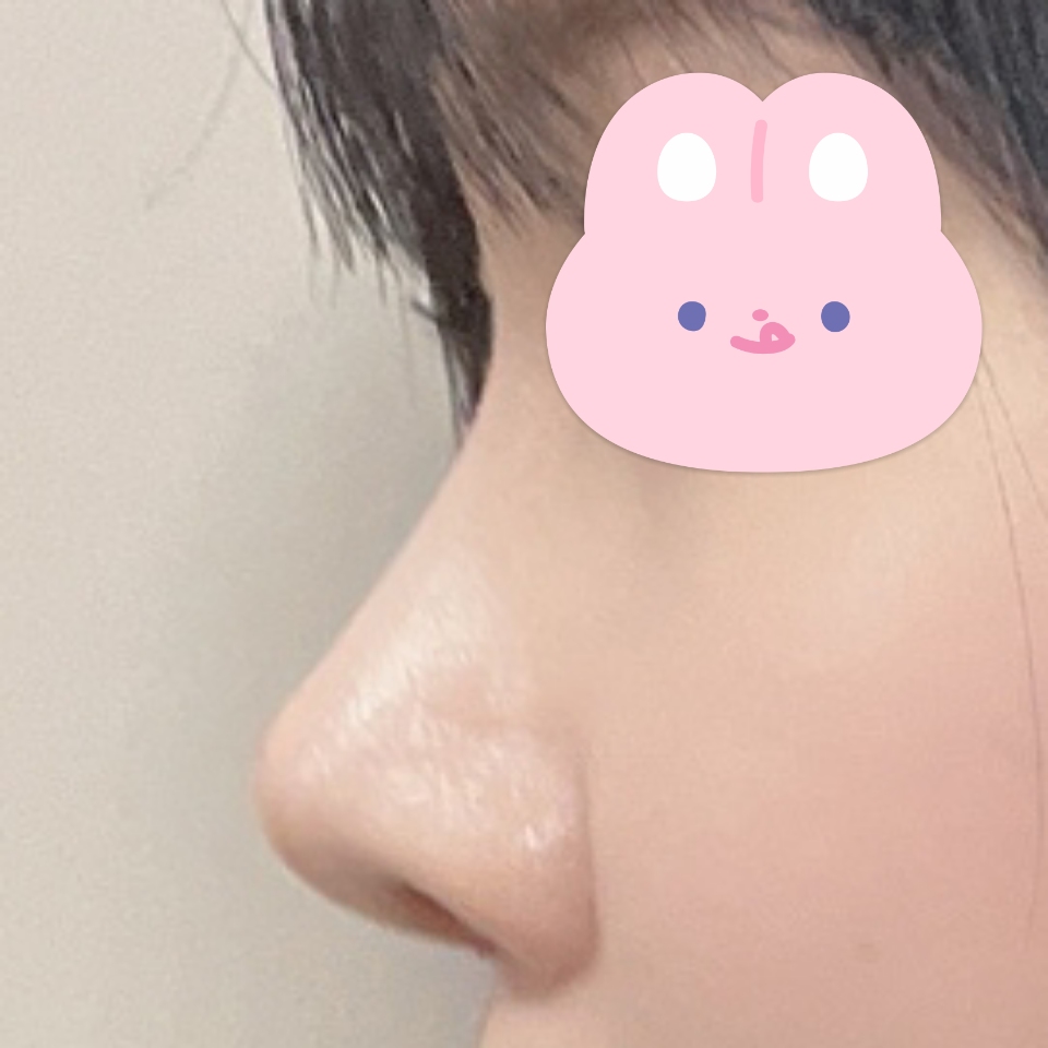 코수술 맛집은 바이브네용