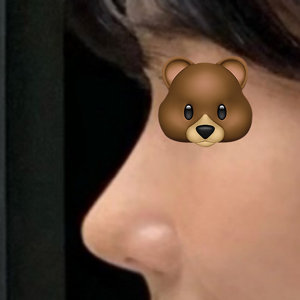 코재수술 3개월차 입니다 ㅎㅎ