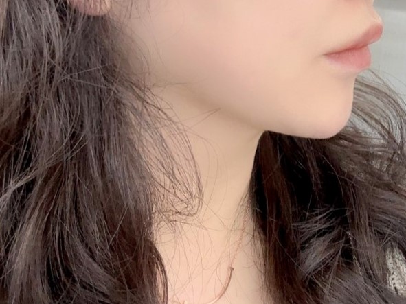 이중턱 지방흡입 대만족입니다 !!