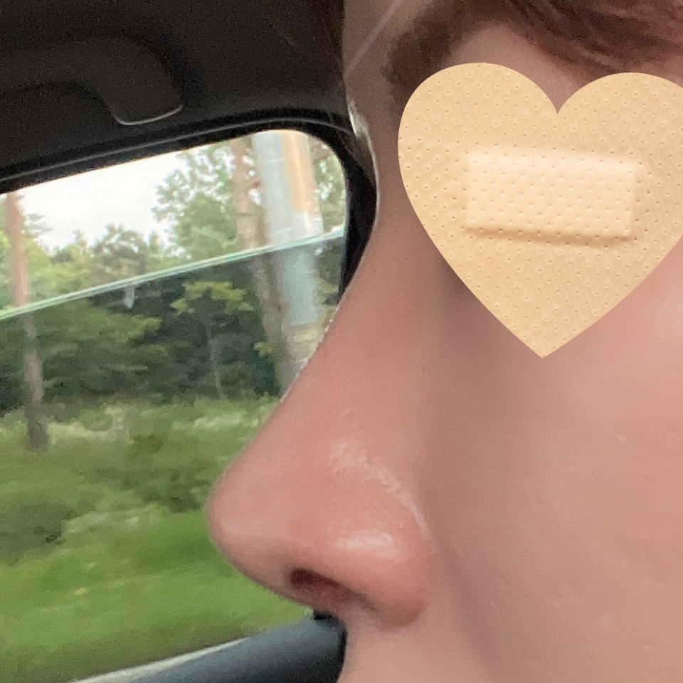 바이브에서 코수술 6개월차 후기입니다 ~!