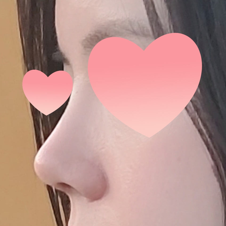 코수술 후 만족스러워서 추천하고 다녀요!