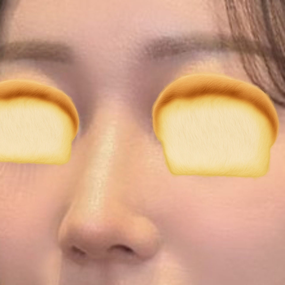 이제 코 때문에 스트레스 안 받아요 !