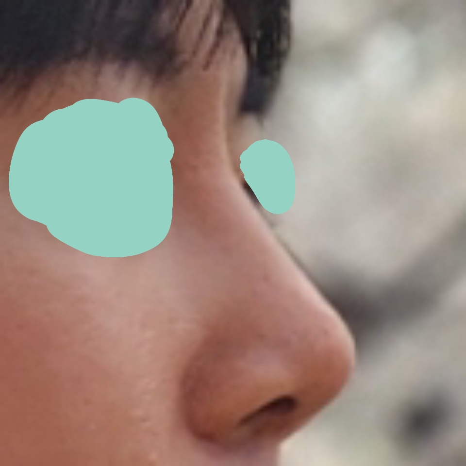 코성형 후 훨씬 남자다워 보입니다 !