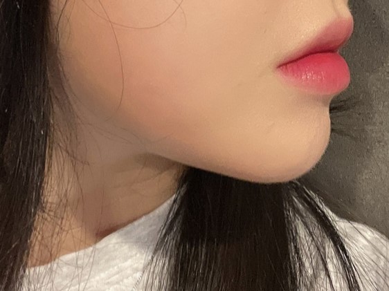 이중턱 지방흡입 바이브 추천합니다 !