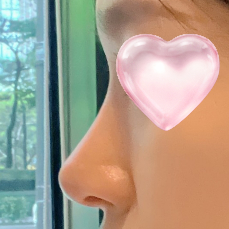 이마거상,코수술 받은지 6개월 지났습니다 ~!