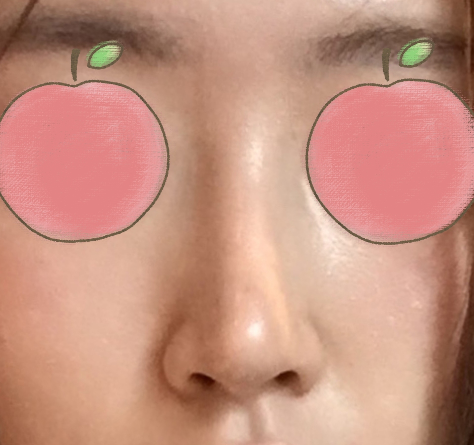 코수술 만족도최고!