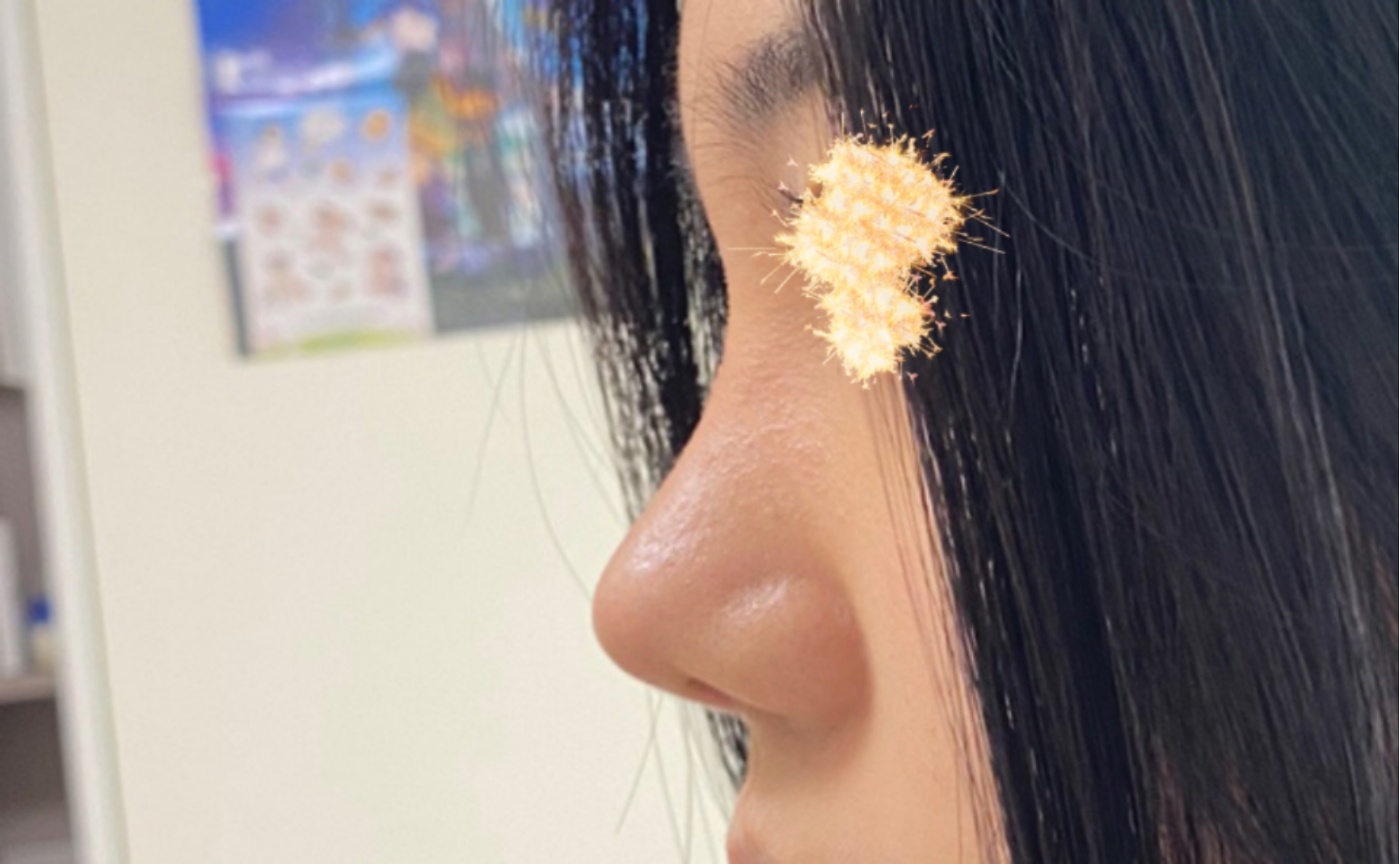 바이브 복코성형 5개월 지났습니다:)