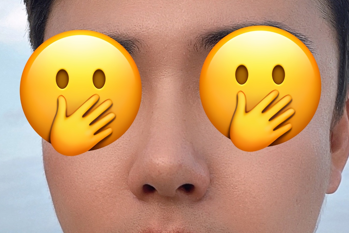 남자 무보형물 코성형 3개월차!