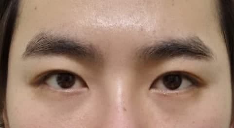 절개눈매교정 재수술 3개월