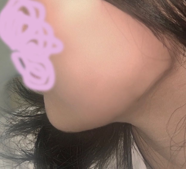 이제 턱살때문에 스트레스가 덜해요 ㅎㅎ
