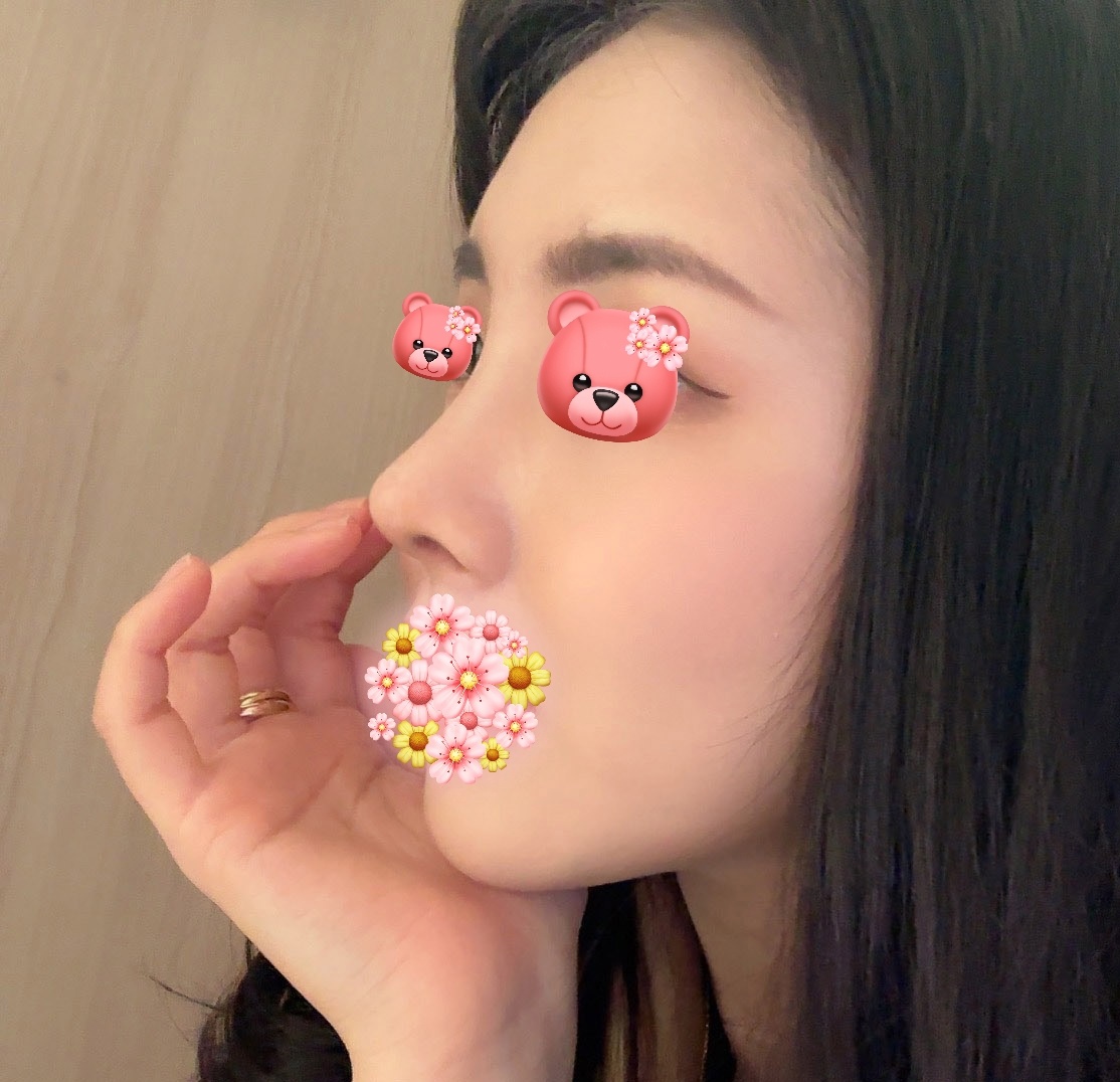 기능코성형 1개월차 찐후기