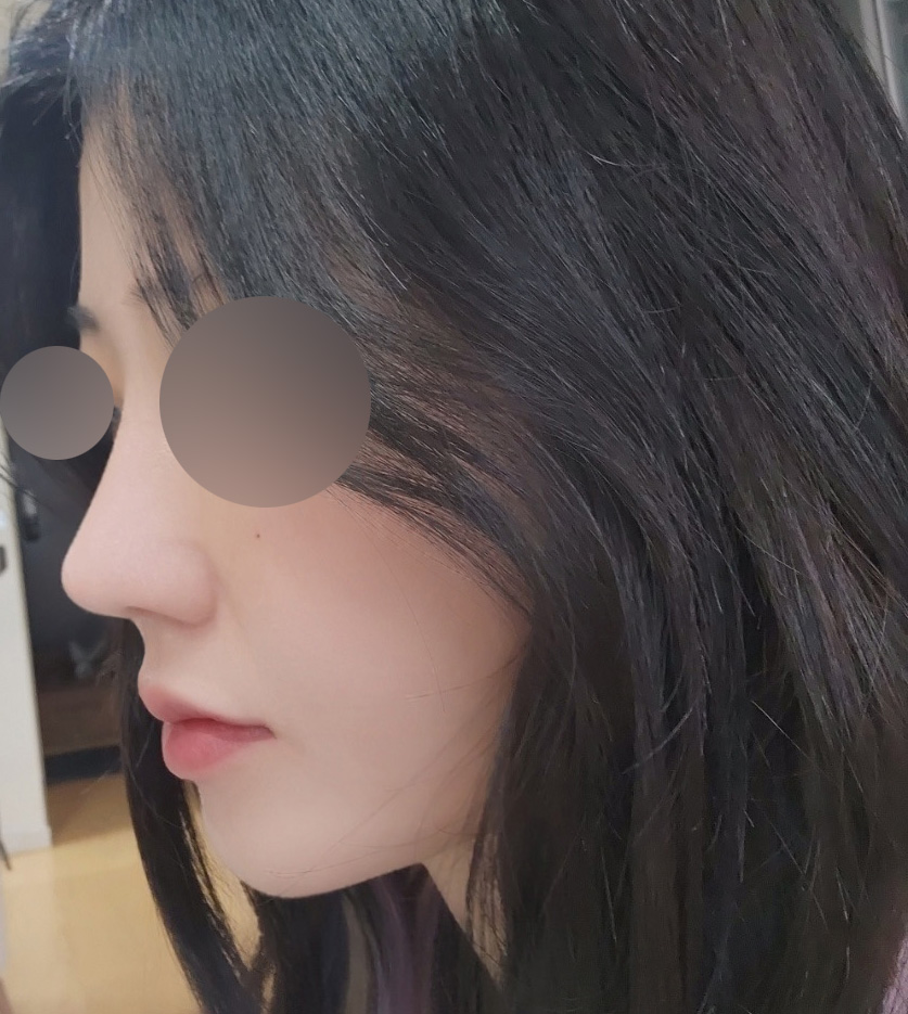 벌써 4개월 지난 이마거상,눈,코,얼굴지흡ㅋㅋㅋㅋㅋ