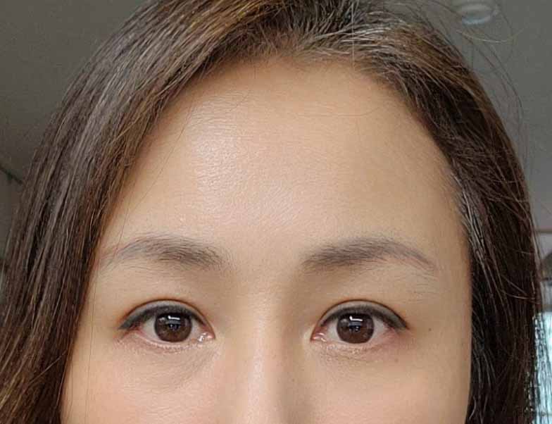 내시경이마거상, 눈 매몰 수술!