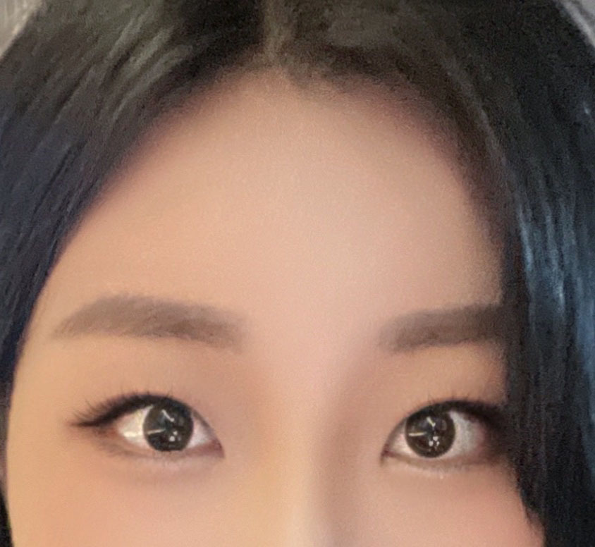 바이브 내시경이마거상 후회 없는 수술이에요:)