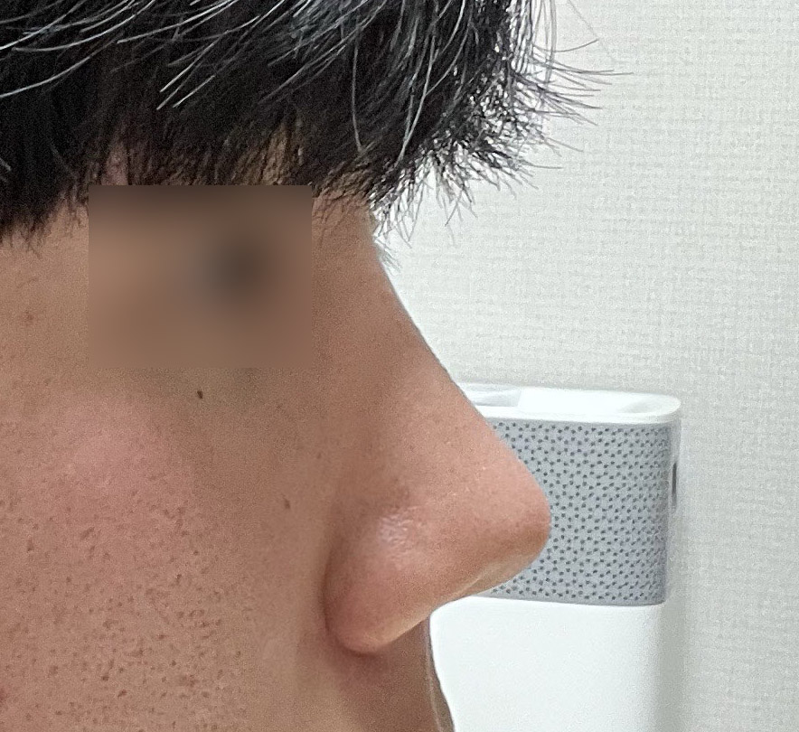 만족스러운 코성형이에요 ㅠㅠ