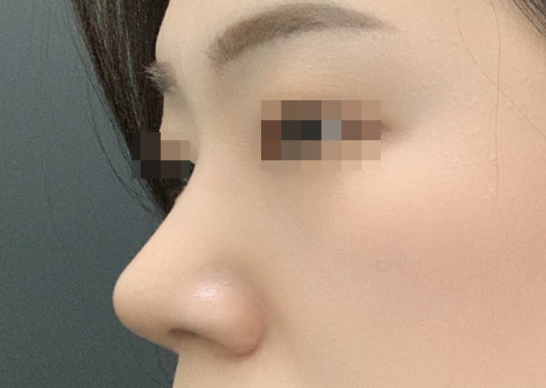 무보형물 코성형 3개월차