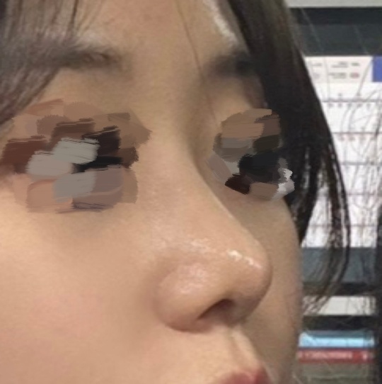매부리코수술 만족 백프로에요!!