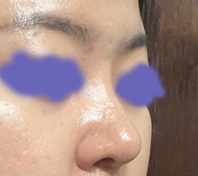 낮은 콧대와 퍼진 복코, 얄쌍하게 됐어요