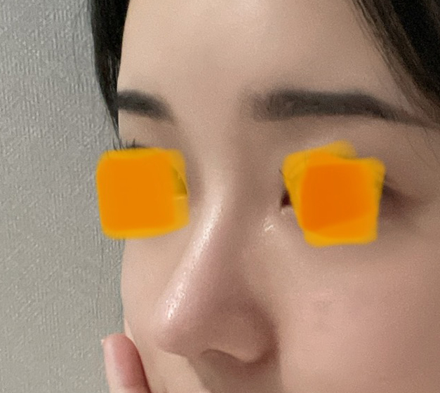 여기가 마지막수술이 될거같아요:) 코재수술후기!