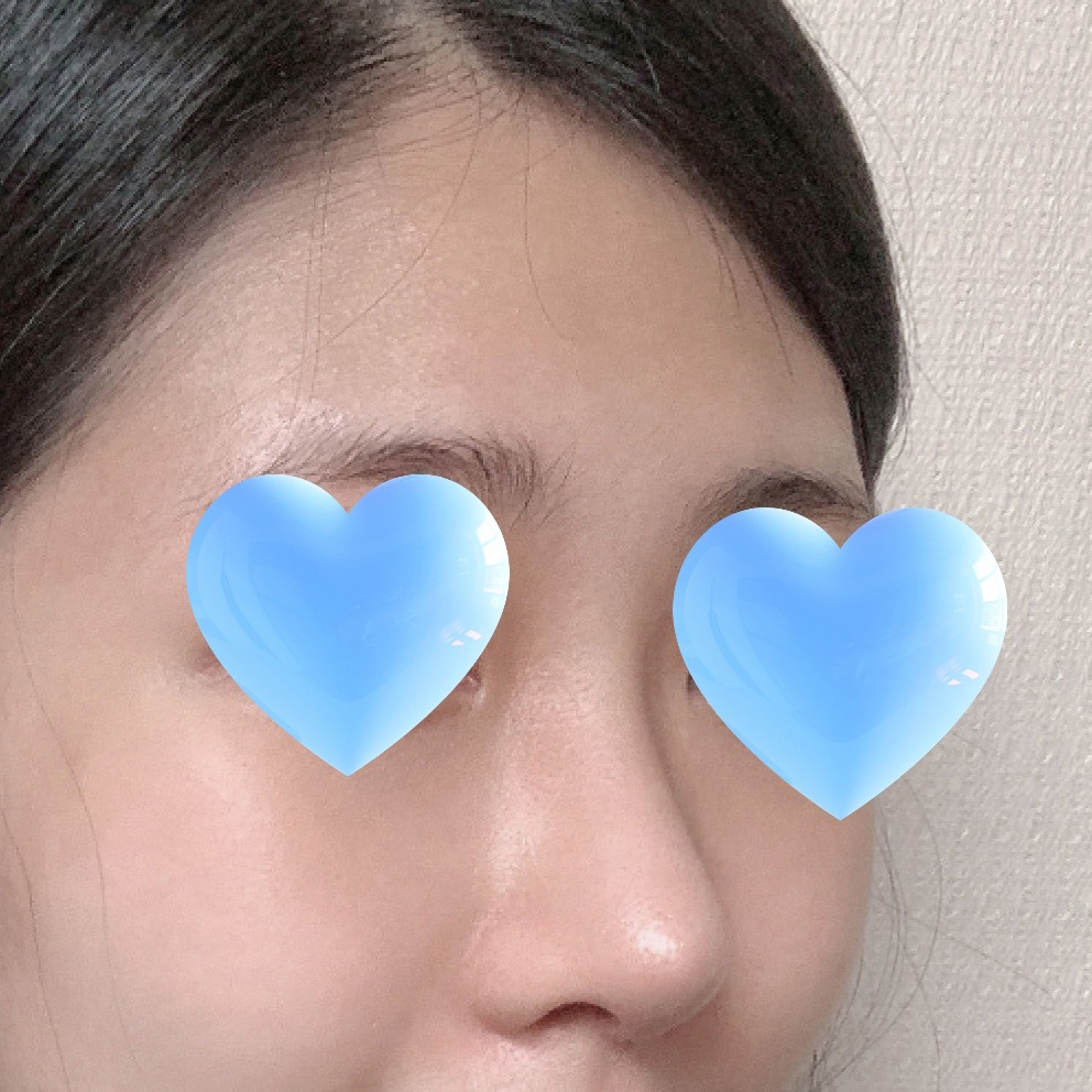 무보형물로 3개월