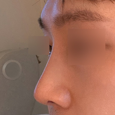 코가 자연스럽고 남자답게 잘됐어요