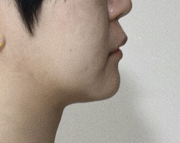 턱살이랑 이별해서 좋네용