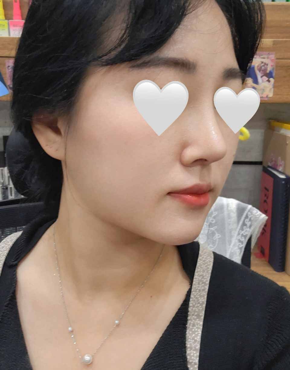 기증늑 사용해서 코수술했어요~