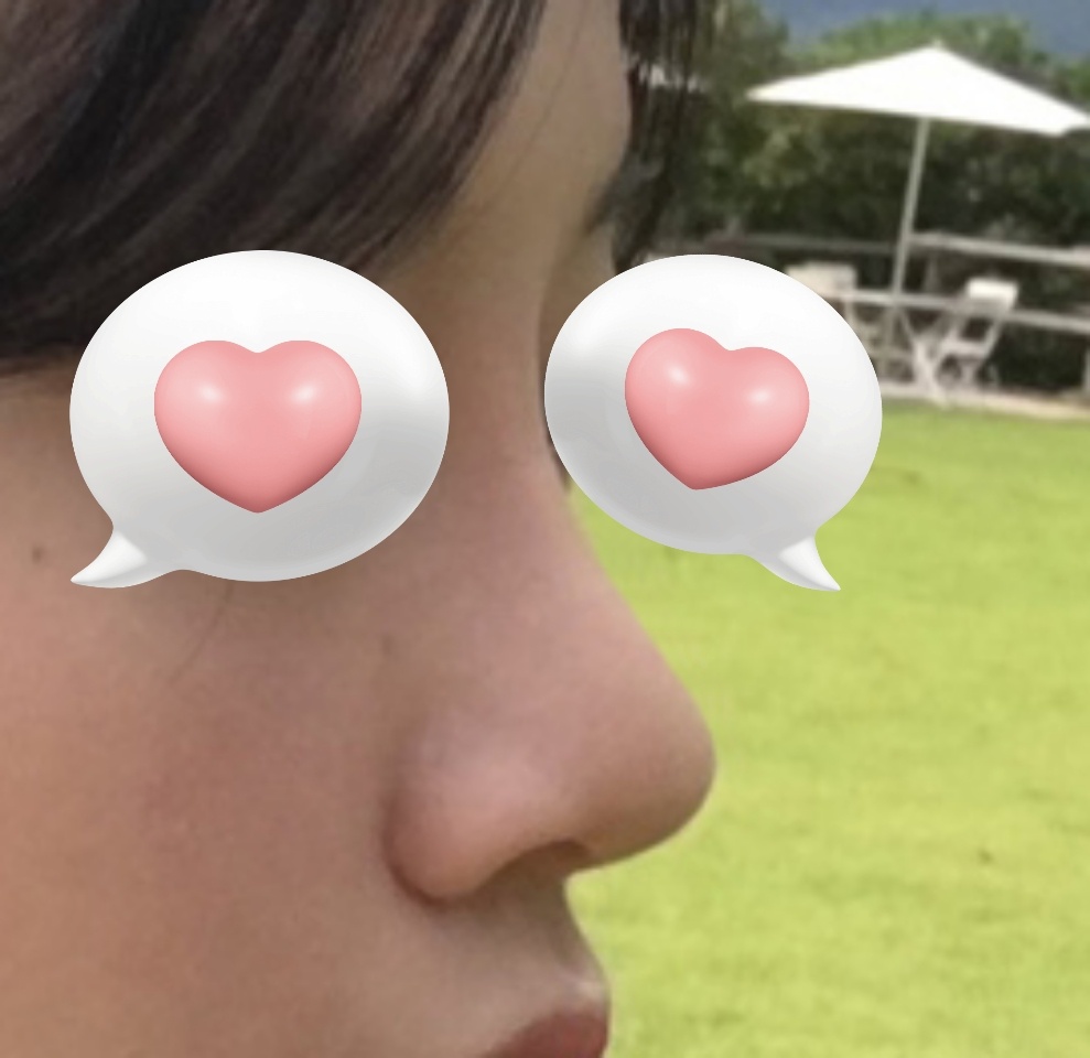 코수술후 숨쉬는 것도 좋아지고 모양도 만족~~!!