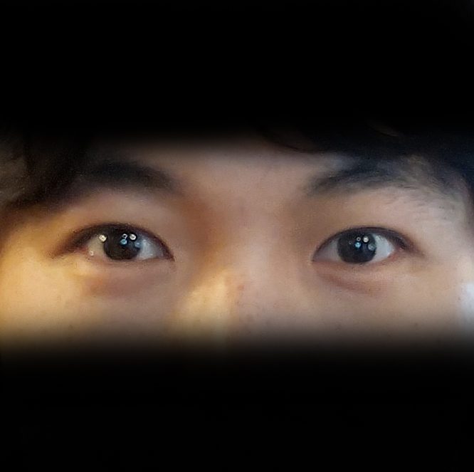 비절개눈매교정+앞트임한지 반년 지났네요