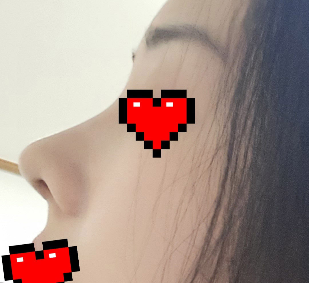 무보형물코 성공후기-3주차