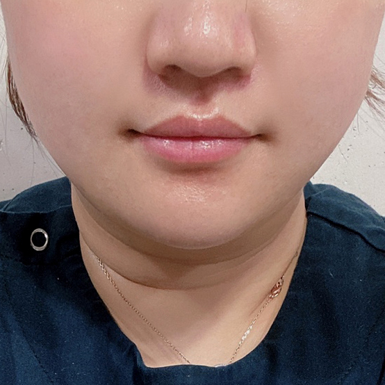 이중턱 효과 직빵!!!!!!