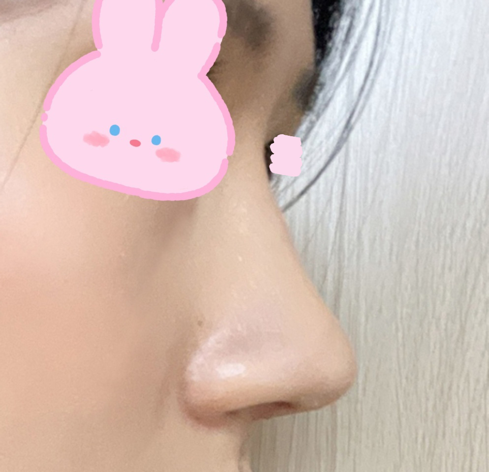 매부리코교정 진짜 전후차이 대박대박