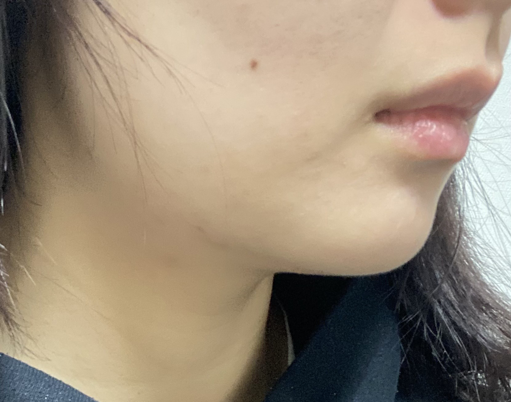 이중턱지방흡입 찐후기에요