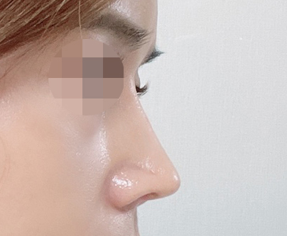 코성형 진작할걸 그랬어요~