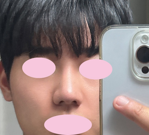 남자코성형 6개월차!! 병원잘골른거같아요!