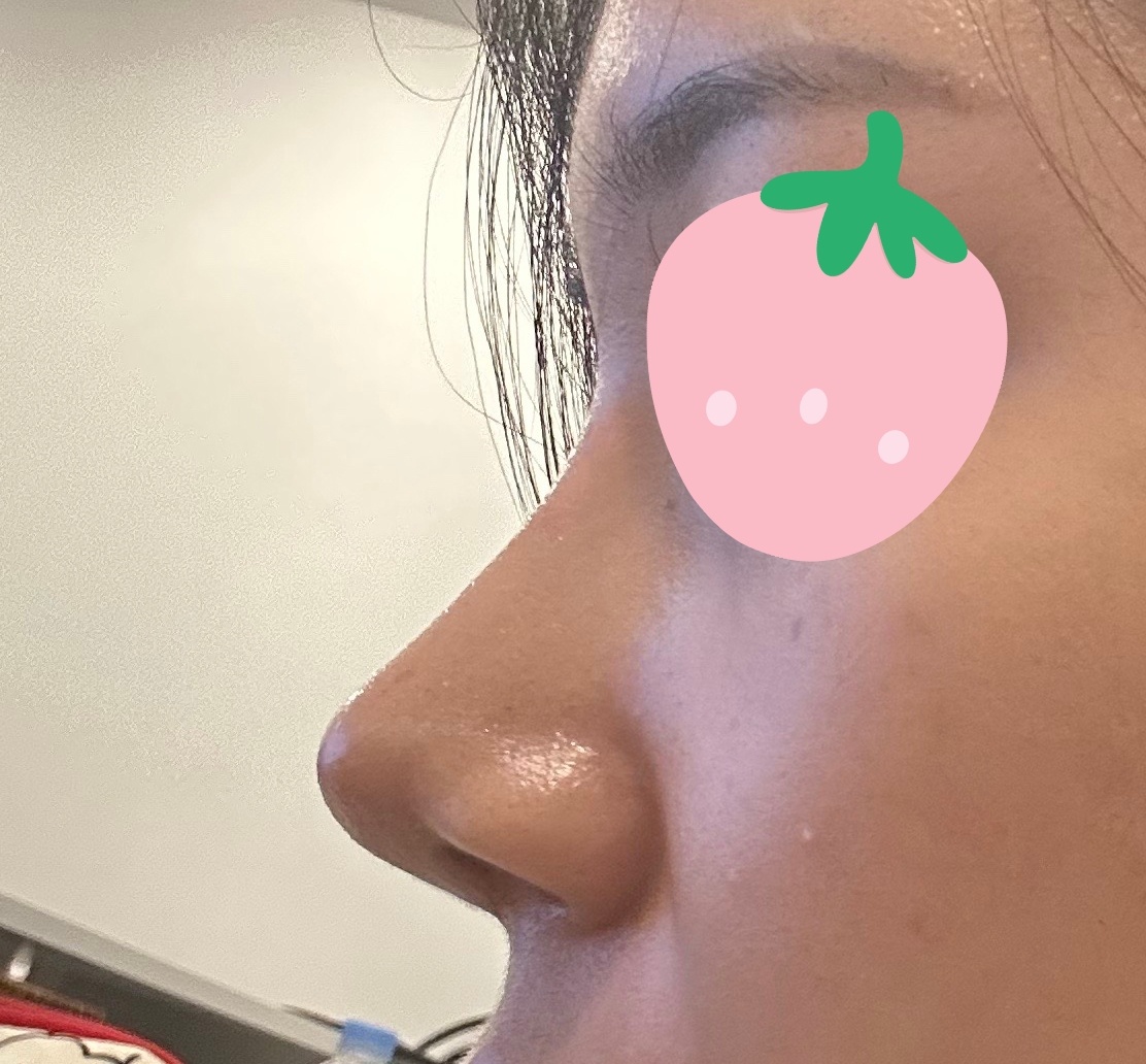 코성형 1달지나고 후기남깁니다!