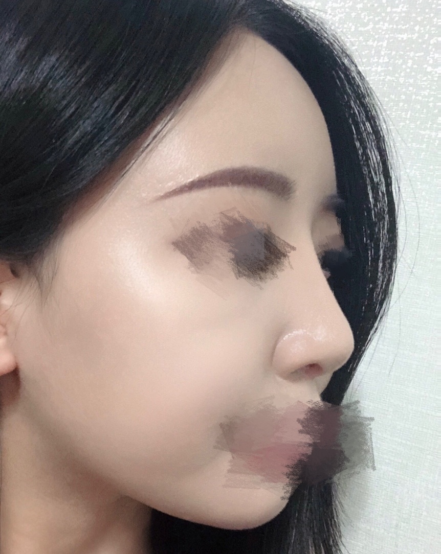 바이브에서 코랑 지방이식했어요(4개월차)