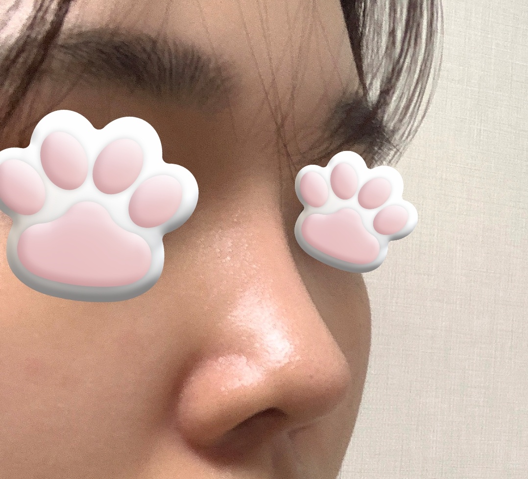 눈, 코 예쁘게 만들어주셨어요!4개월차후기!!