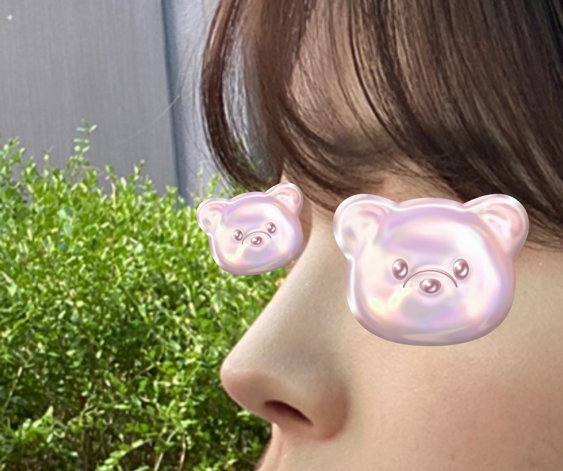 무보형물코성형 6개월차 후기