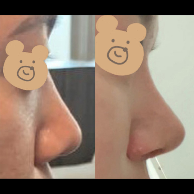 원장님께서 이쁜 코 만들어주셨어요~!