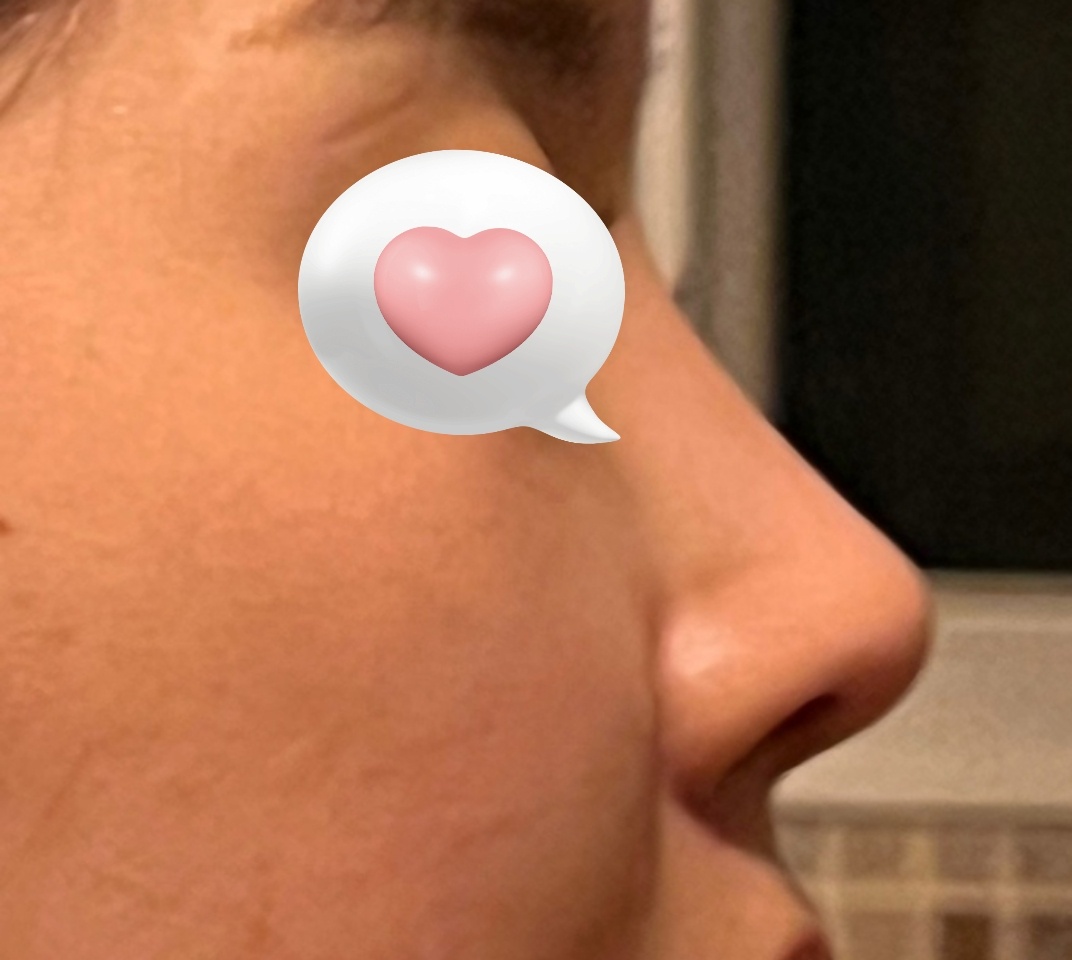 코재수술 바이브에서 성공!