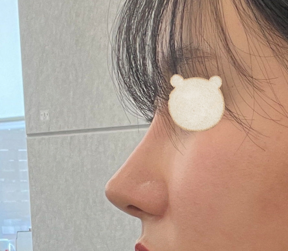 코성형알아보시면 바이브에서 하세용ㅎㅎ