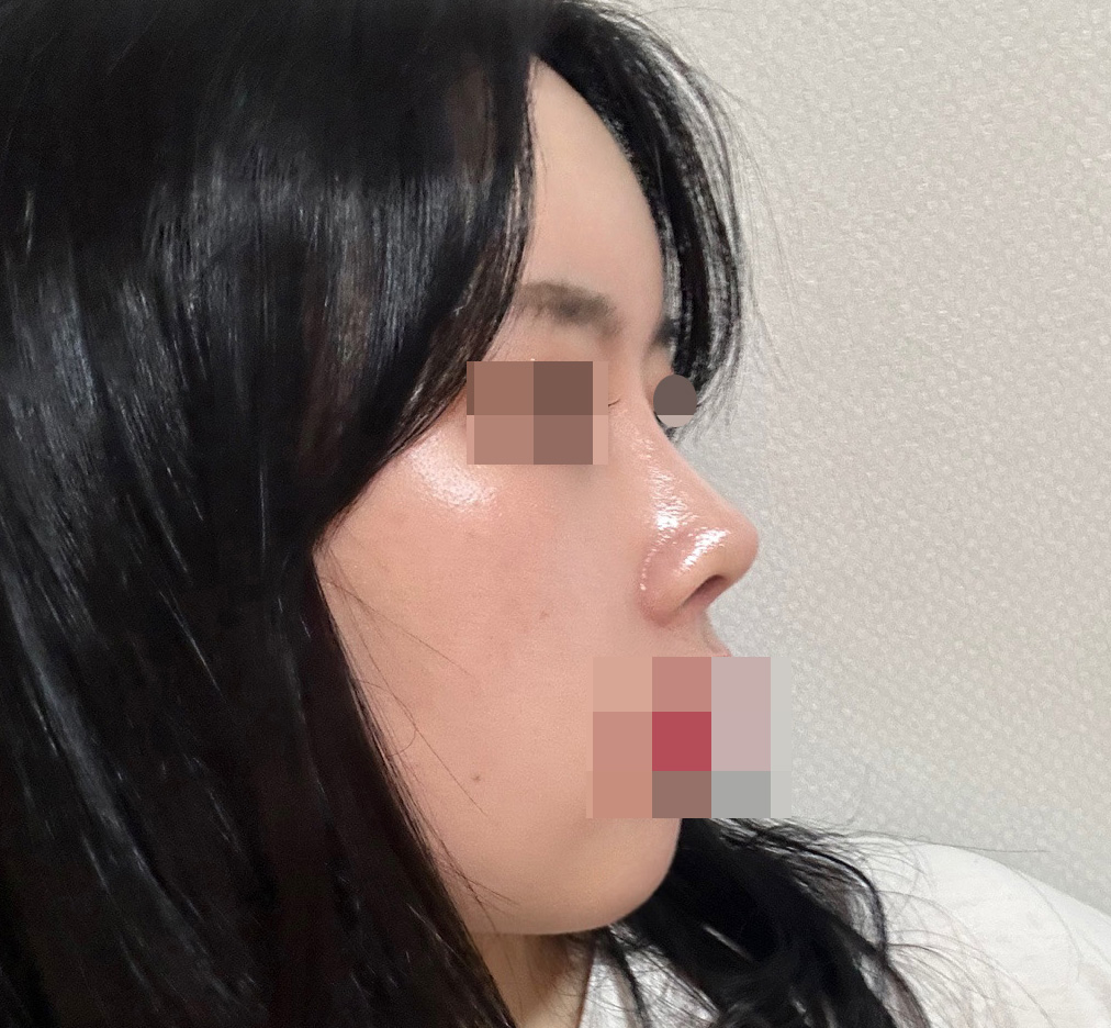 첫성형인데 잘된거같아요:)