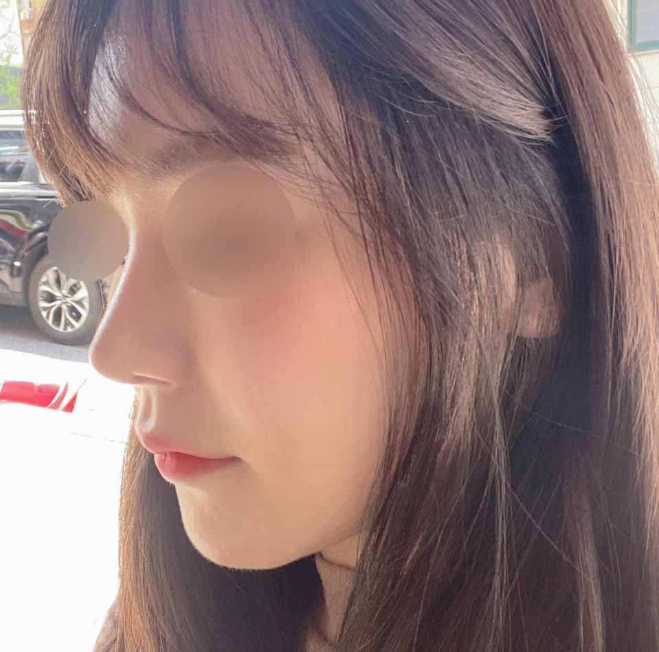 코, 얼굴지흡 전체적으로 정말 만족스럽습니당