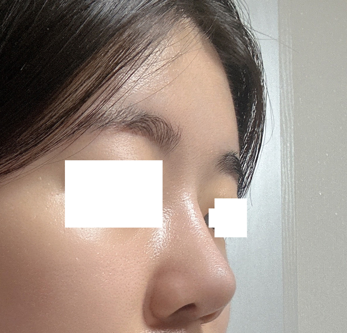 바이브에서 수술한지 벌써 4개월흘러갑니다!!