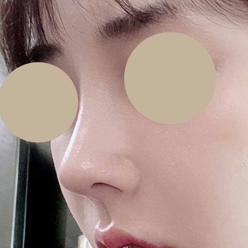 기증늑 사용해서 코재수술